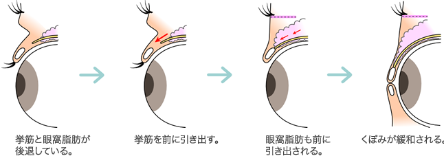 挙筋前転法