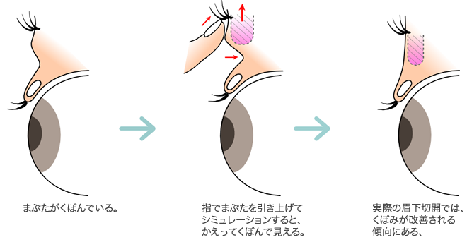 シミュレーションと実際の眉下切開
