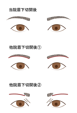 眉下切開の適応と現在の美容外科の状況