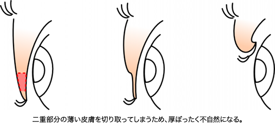 二重のラインで皮膚を切る方法